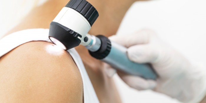 mole removal